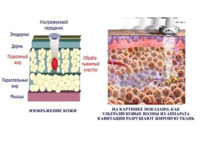 Ультразвукова кавітація особливості, протипоказання відгуки, вправи для схуднення