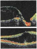 Ямка диска зорового нерва ямка диска зорового нерва