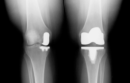Ціна повного ендопротезування колінного суглоба в Чебоксарах