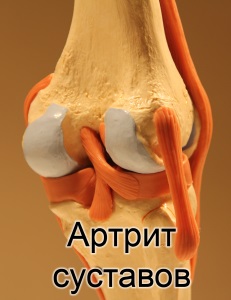 Артрит колінного суглоба лікування народними засобами