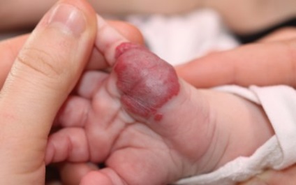Гемангіома на пальці ноги або руки у дорослих і дітей, лікування