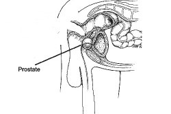 Contraindicații ale adenomului de prostată pentru tratamentul spa
