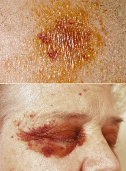 Амілоїдоз шкіри симптоматика при різних формах патології, лікування, прогноз