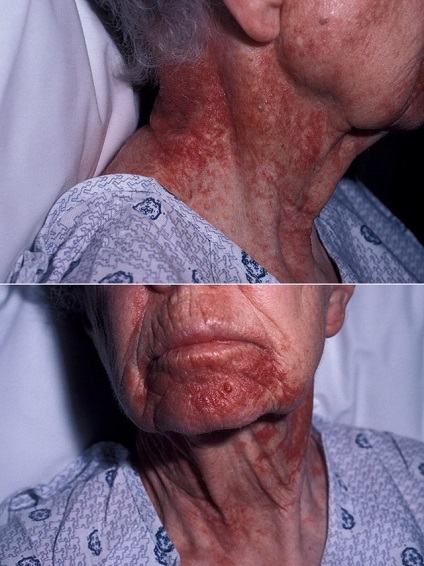 Амілоїдоз шкіри симптоматика при різних формах патології, лікування, прогноз