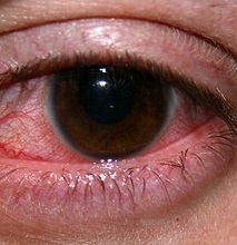 Кератит (запалення рогівки ока) причини, ознаки (симптоми) і лікування - клініки і лікарі