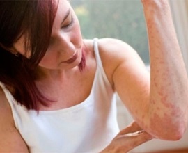 Кропив'янка - дерматологія (шкірні захворювання) - інформаційний портал мої симптоми