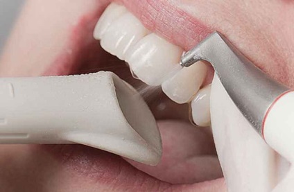 Професійне чищення зубів - скільки коштує, фото до і після, відгуки