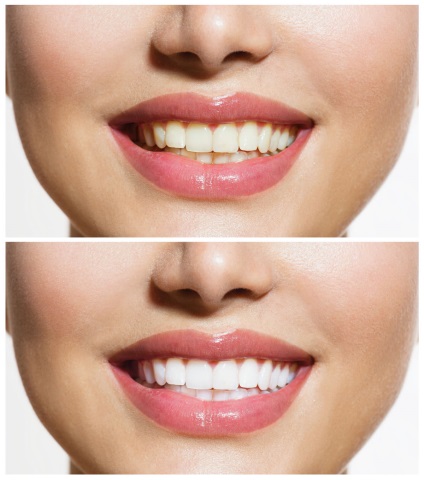 Професійне чищення зубів - скільки коштує, фото до і після, відгуки