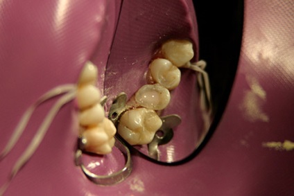 Статті по реставрації зубів