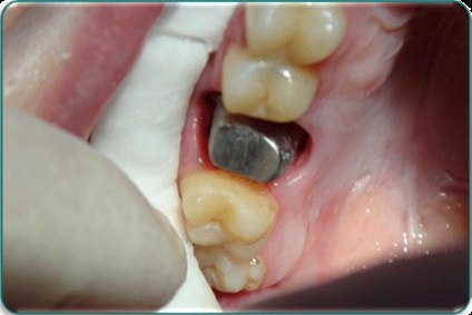 Статті по реставрації зубів