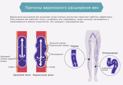 Які вітаміни приймати при лікуванні варикозу - поради і рекомендації