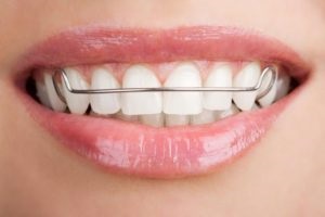 Скоби на зуби - скільки коштує поставити і як ставлять