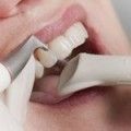 Засіб для відбілювання зубів в аптеках гель і інші препарати