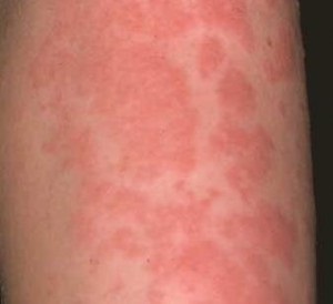 Алергія на курку причини, симптоми, діагностика та лікування