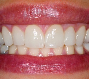 Реставрація фронтальних і жувальних зубів в чому різниця