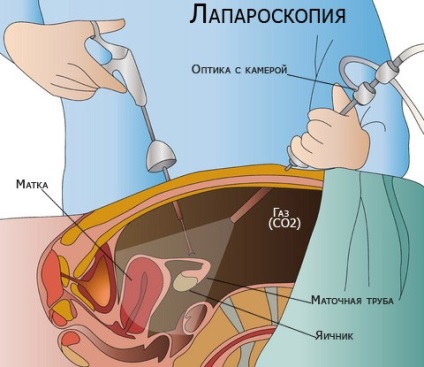 Відновлення та реабілітація після лапароскопії яєчників і матки