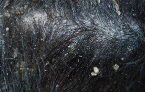 5 П'ять поширених причин сверблячки голови і випадання волосся, нарости на шкірі