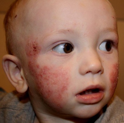 Алергічний дерматит у дитини в різному віці лікування (в тч народне) та ін аспекти фото