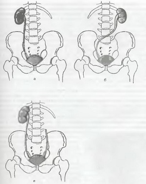 Аплазія нирки з правого і з лівого боку, чим відрізняються і як лікувати
