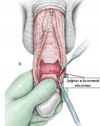 A pénisz péniszének szerkezete, Férfi nemi szervek – Wikipédia