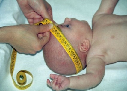 Підвищений внутрішньочерепний тиск у немовлят і немовлят