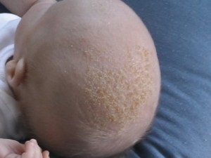 Себорейний дерматит причини, симптоми, лікування, фото, блог про волосся