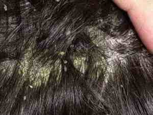 Себорейний дерматит причини, симптоми, лікування, фото, блог про волосся