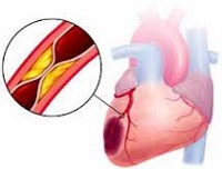 Інфаркт міокарда - причини, симптоми, діагностика та лікування