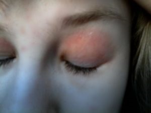 Алергія на міцелярно воду - чому з'являється і як зняти алергічну реакцію