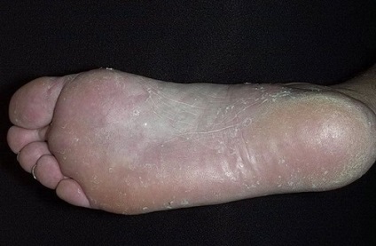 Лікування грибка стопи і нігтів на ногах