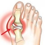 7 Причин запалення кісточки на великому пальці ноги, як лікувати