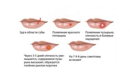 Як жінка може заразитися герпесом симптоми і лікування