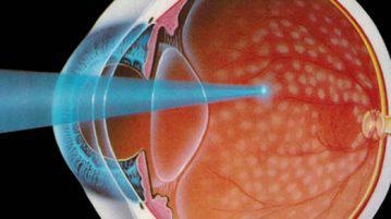 Coagulare cu vedere laser, Coagulare cu laser a retinei
