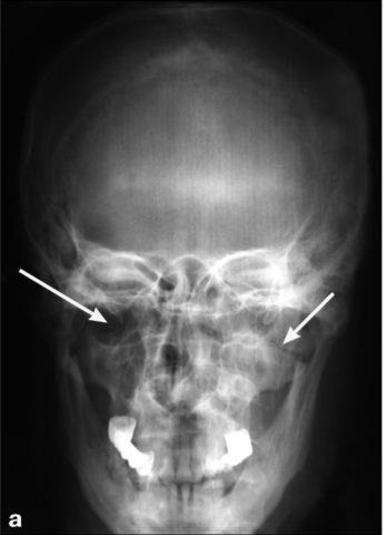 Перелом верхньої щелепи - класифікація, особливості клінічної картини і лікування