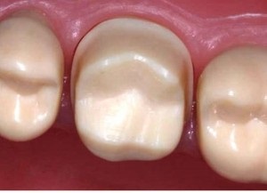 Препарування зубів під коронки - суцільнолиті, штамповану, пластмасову