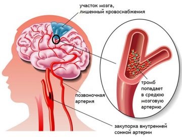 Чистка судин головного мозку