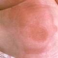 Еритематозна попрілість - опис хвороби дерматит травматичний, ознаки та причини захворювання
