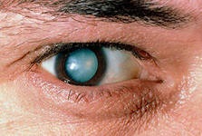 Катаракта - лікування катаракти