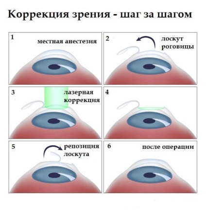 cum să tratezi ochii hipermetropi mica miopie