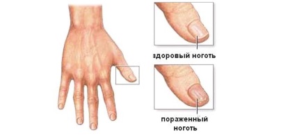 Псоріаз нігтів пальців рук симптоми, причини, лікування препаратами та народними засобами