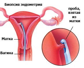 біопсія ендометрія