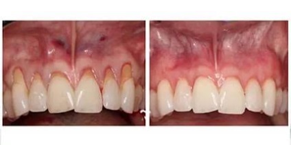Лікування ясен зубів, лікування періодонтиту в москві