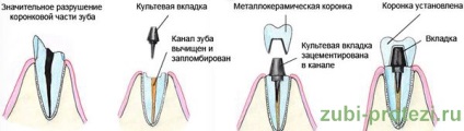 Металокерамічна коронка на зуб ціна 7000 руб; металокераміка на зуби відгуки, фото, вартість,