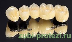 Металокерамічна коронка на зуб ціна 7000 руб; металокераміка на зуби відгуки, фото, вартість,