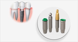 По-справжньому якісна стоматологія та імплантація