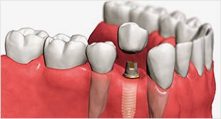 По-справжньому якісна стоматологія та імплантація