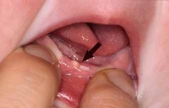 Діагностика та лікування уражень порожнини рота у новонароджених - дитяча стоматологія - новини і