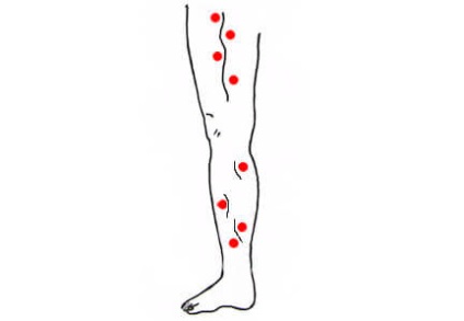 Schema de fixare a lipitorilor cu varice și tromboflebite ale picioarelor