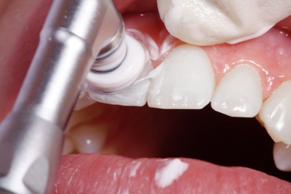 Як позбутися від зубного нальоту особливості чищення зубів в стоматології