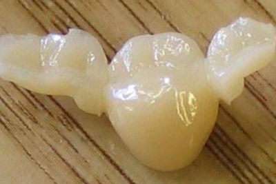 Мостовидні протези - якісне відновлення зубного ряду - про виправлення прикусу і брекети